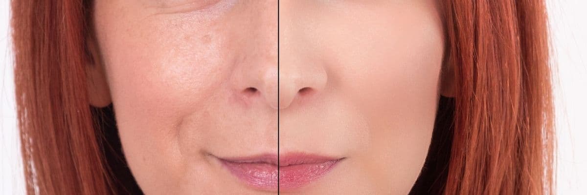 Genius RF Microneedling